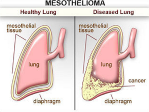 What is Mesothelioma?