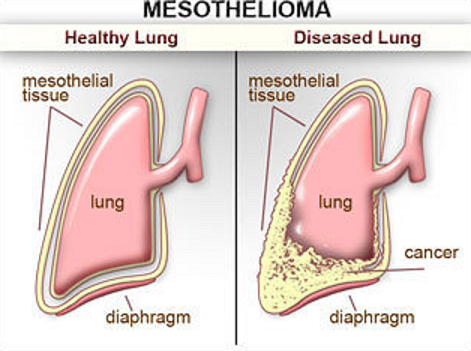 Mesothelioma